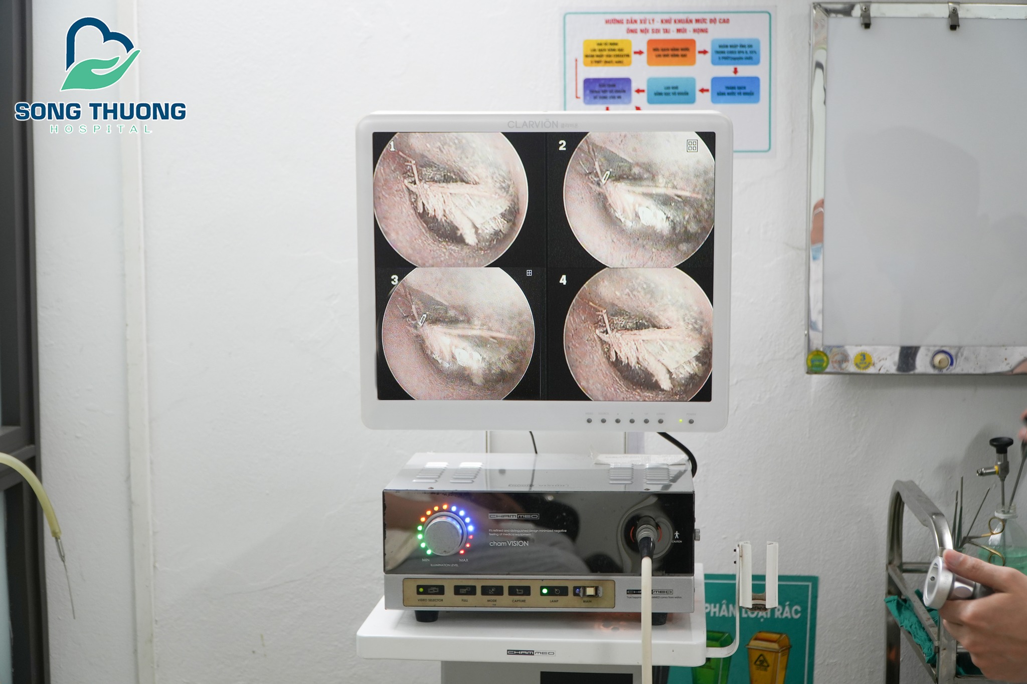 BỆNH VIỆN ĐA KHOA SÔNG THƯƠNG TIẾP NHẬN VÀ XỬ LÝ TRƯỜNG HỢP BỆNH NHÂN BỊ CÔN TRÙNG BAY VÀO TAI