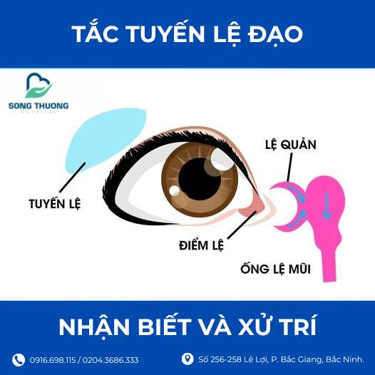 TẮC LỆ ĐẠO - NHẬN BIẾT VÀ XỬ TRÍ
